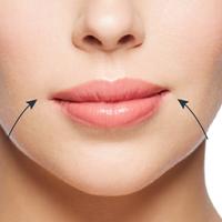 Nasolabial Folds Lower FaceAround the Mouth Filler